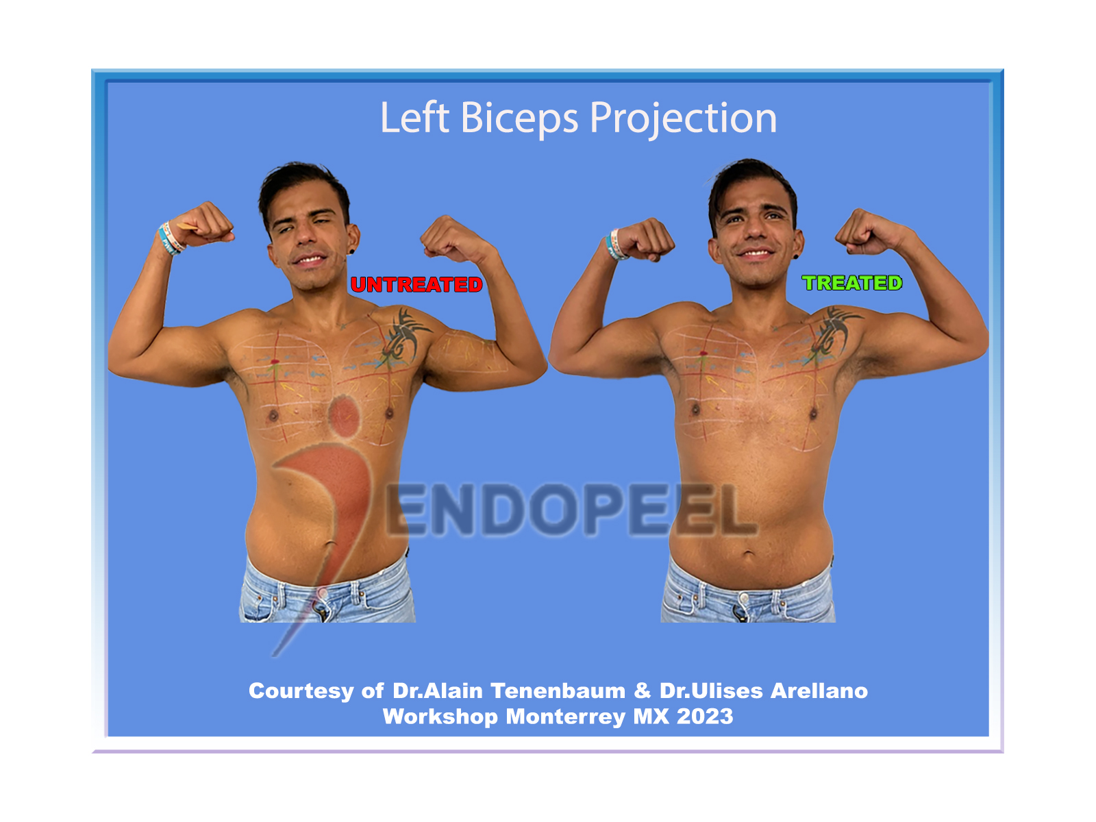 left-biceps-projection-anterior-view