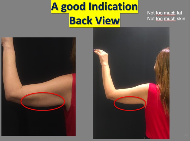 step1-photo-back-view