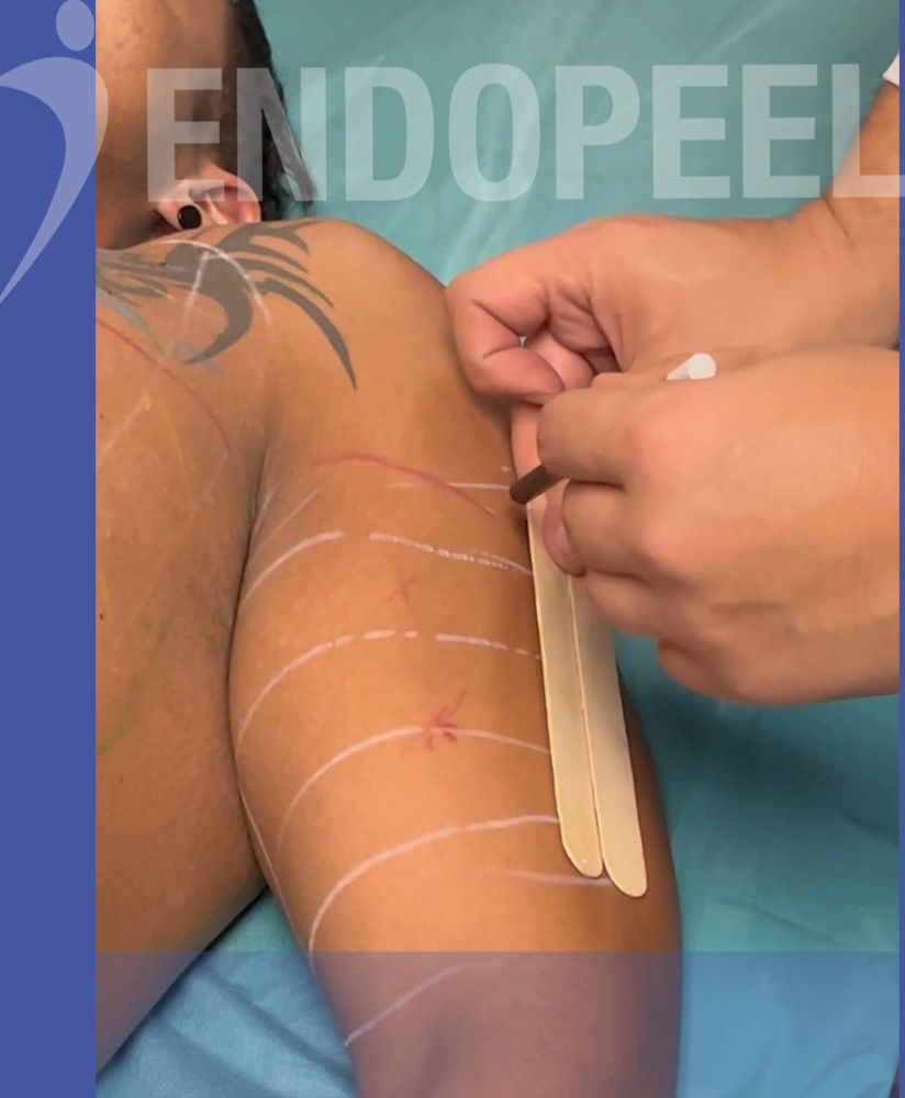 Step4-vertical-division-biceps-area