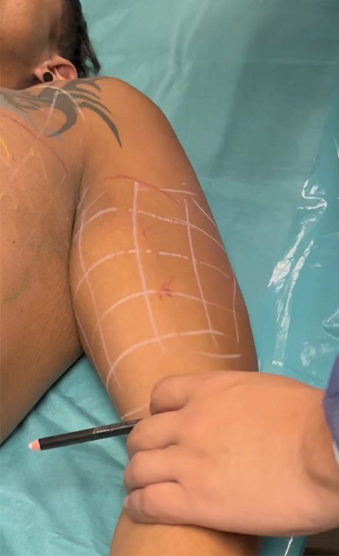 Step4-vertical-division-biceps-area