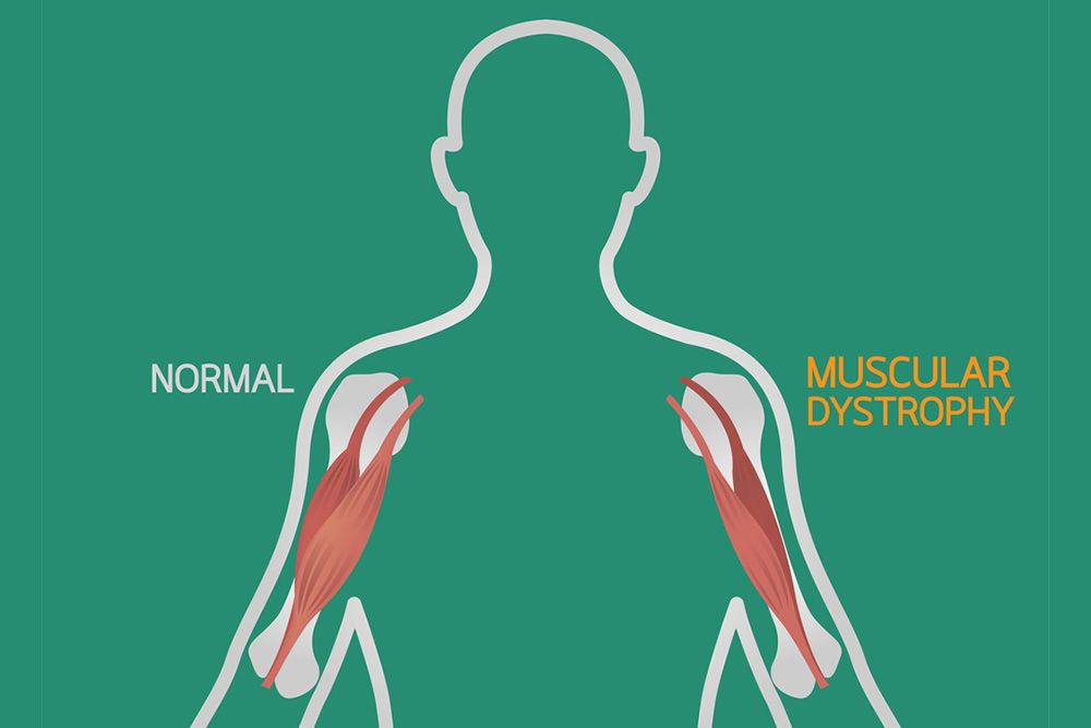 biceps-dystrophy